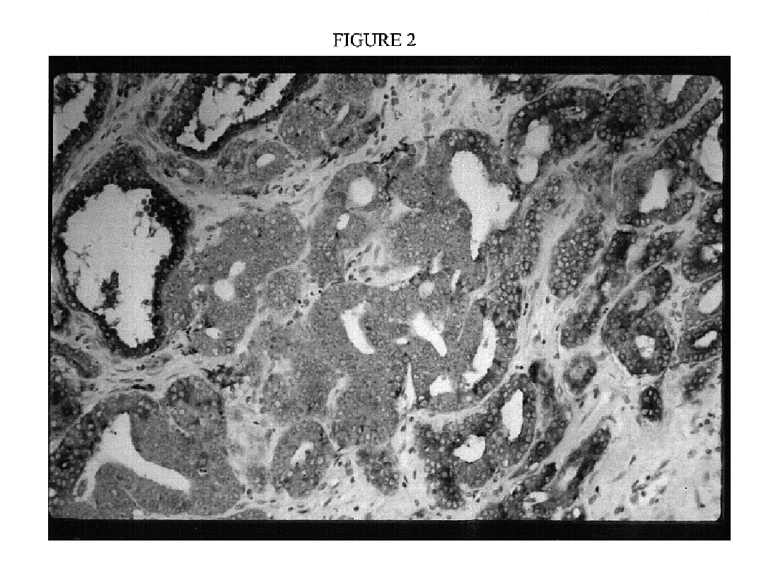 Immortal human prostate epithelial cell lines and clones and their applications in the research and therapy of prostate cancer