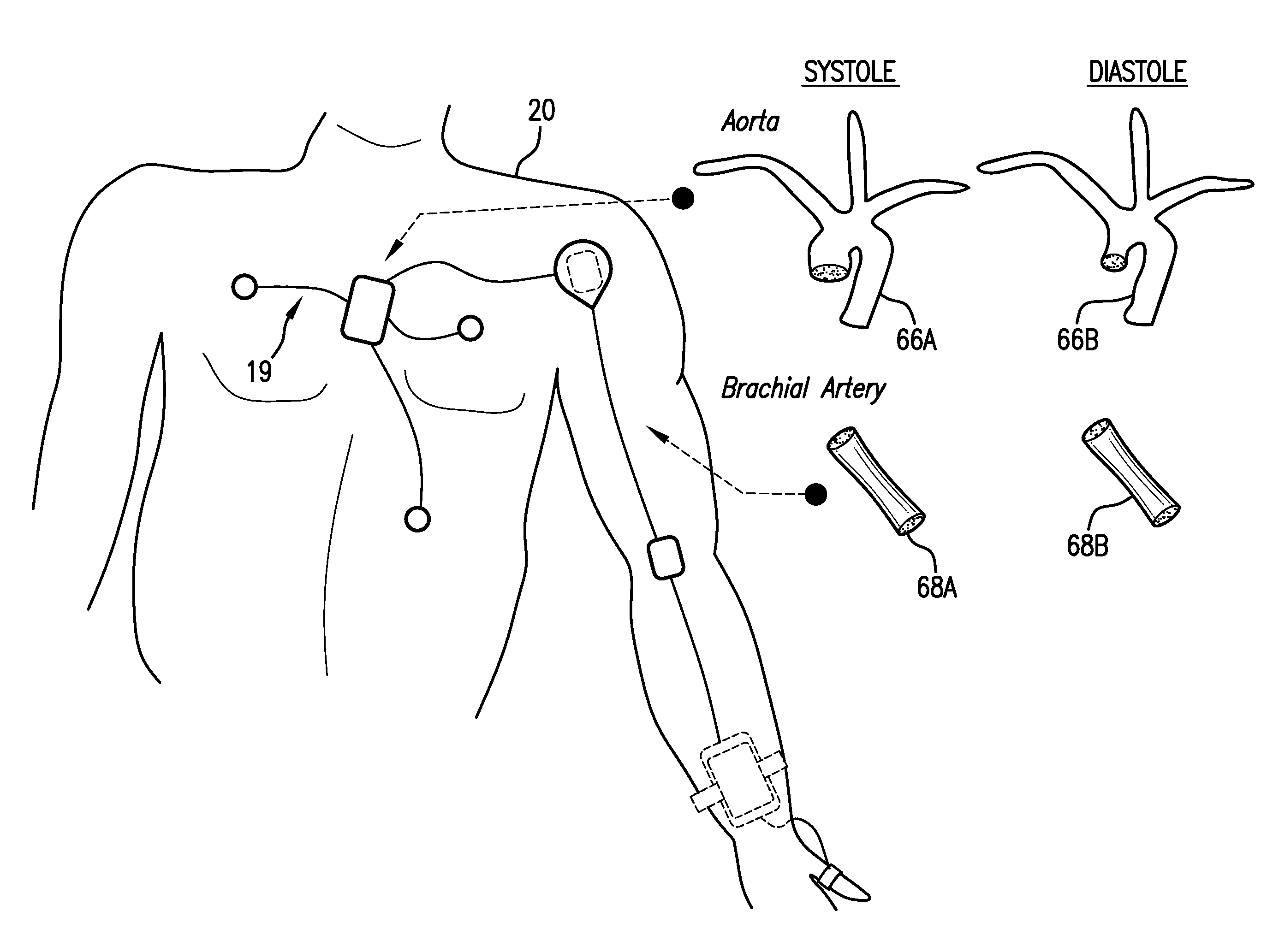 Body-worn system for continuous, noninvasive measurement of cardiac output, stroke volume, cardiac power, and blood pressure