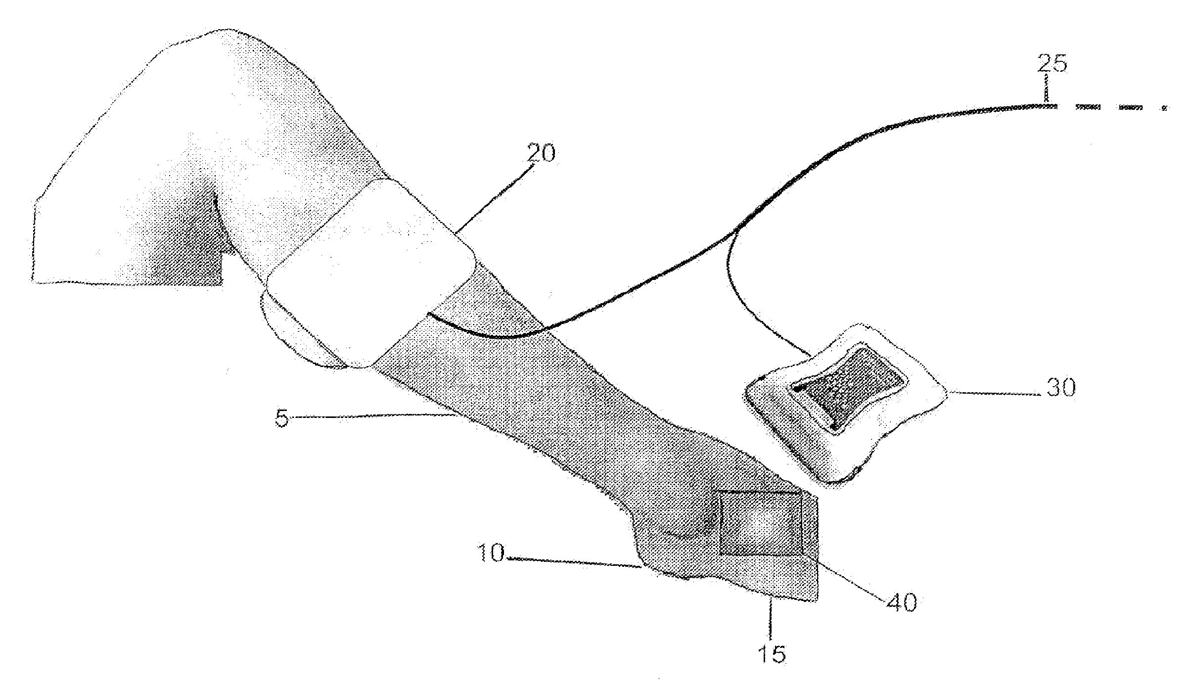 Method of treating a severe diabetic ulcer