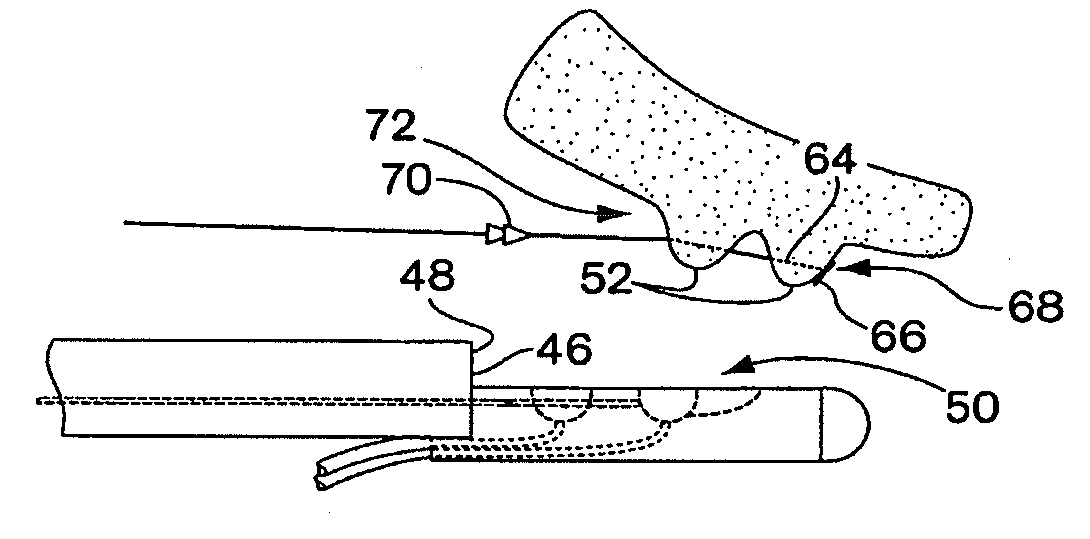 Tissue capturing devices