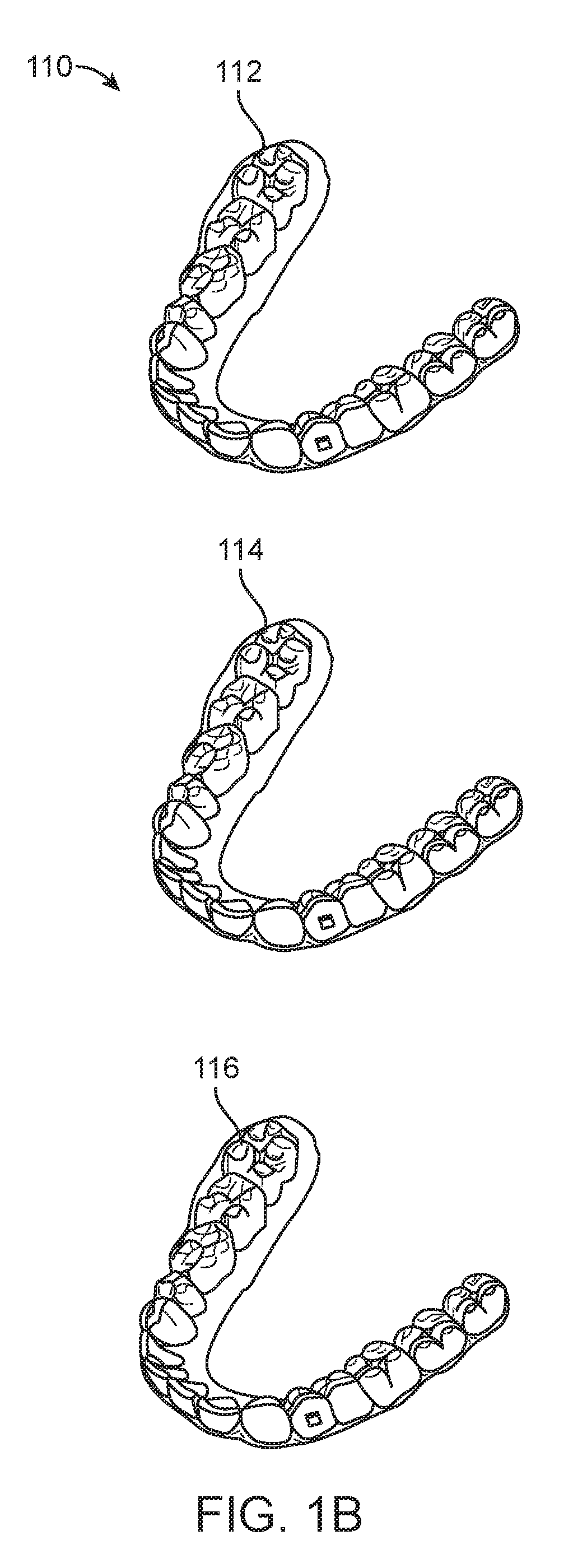 Systems, methods, and apparatus for correcting malocclusions of teeth