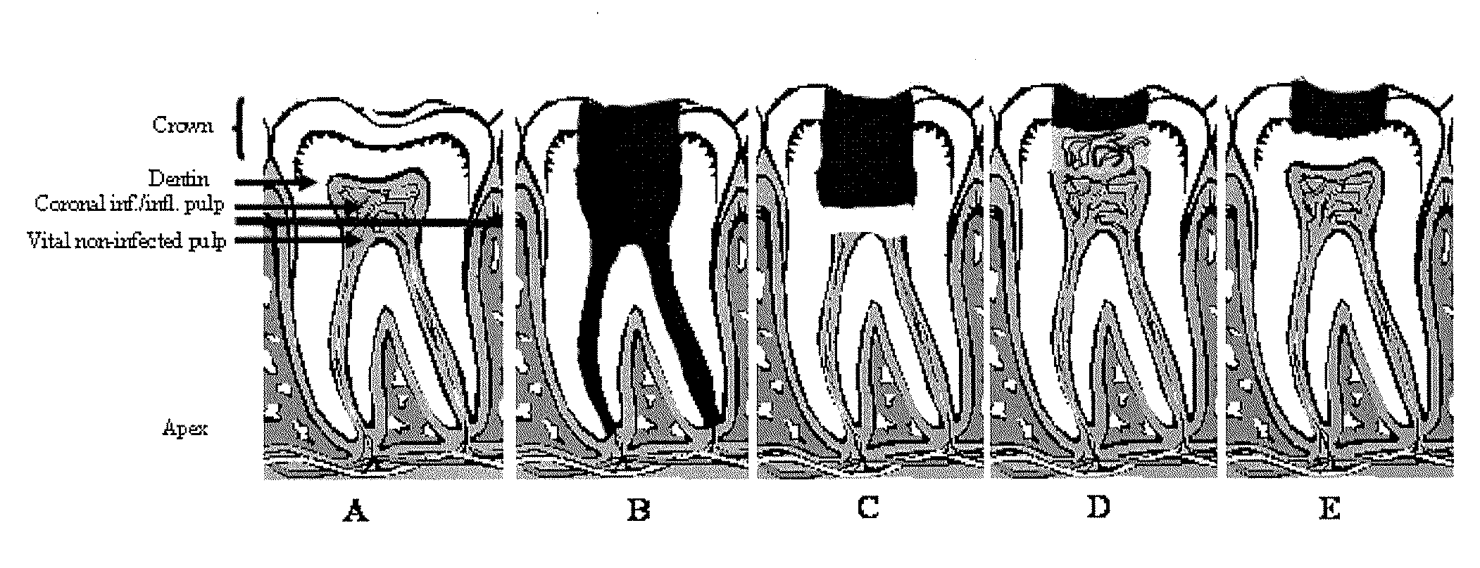 Compositions and methods for treating pulp inflammations caused by infection or trauma