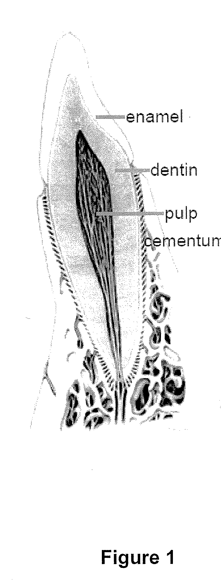 Compositions and methods for treating pulp inflammations caused by infection or trauma