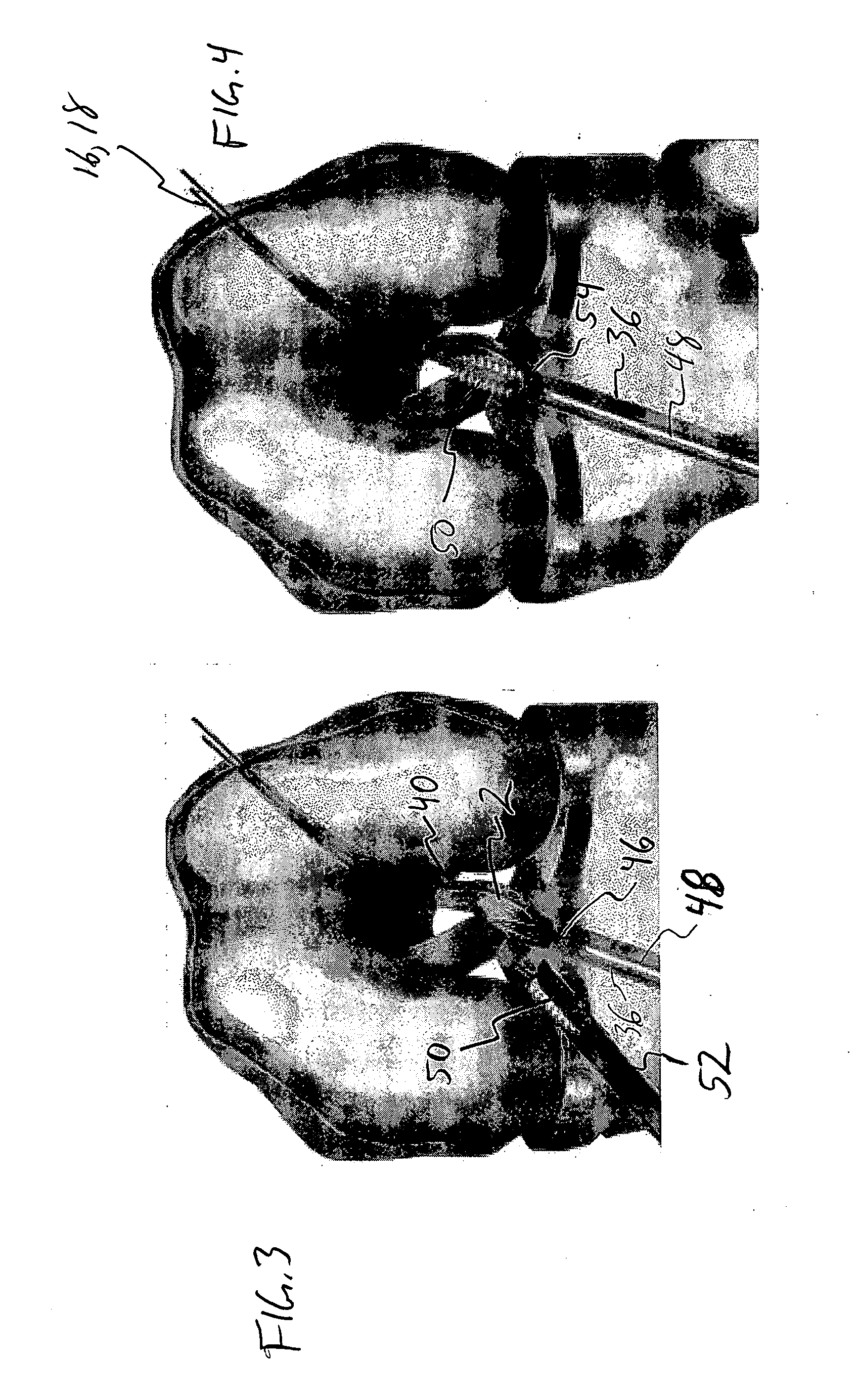 Method for creating a double bundle ligament orientation in a single bone tunnel during knee ligament reconstruction