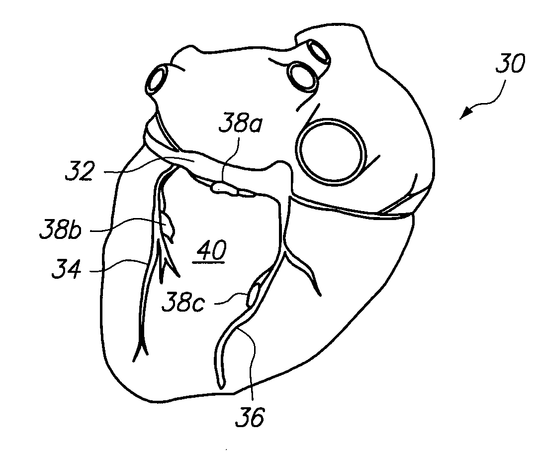 System and method for transvascular activation of cardiac nerves to improve heart function