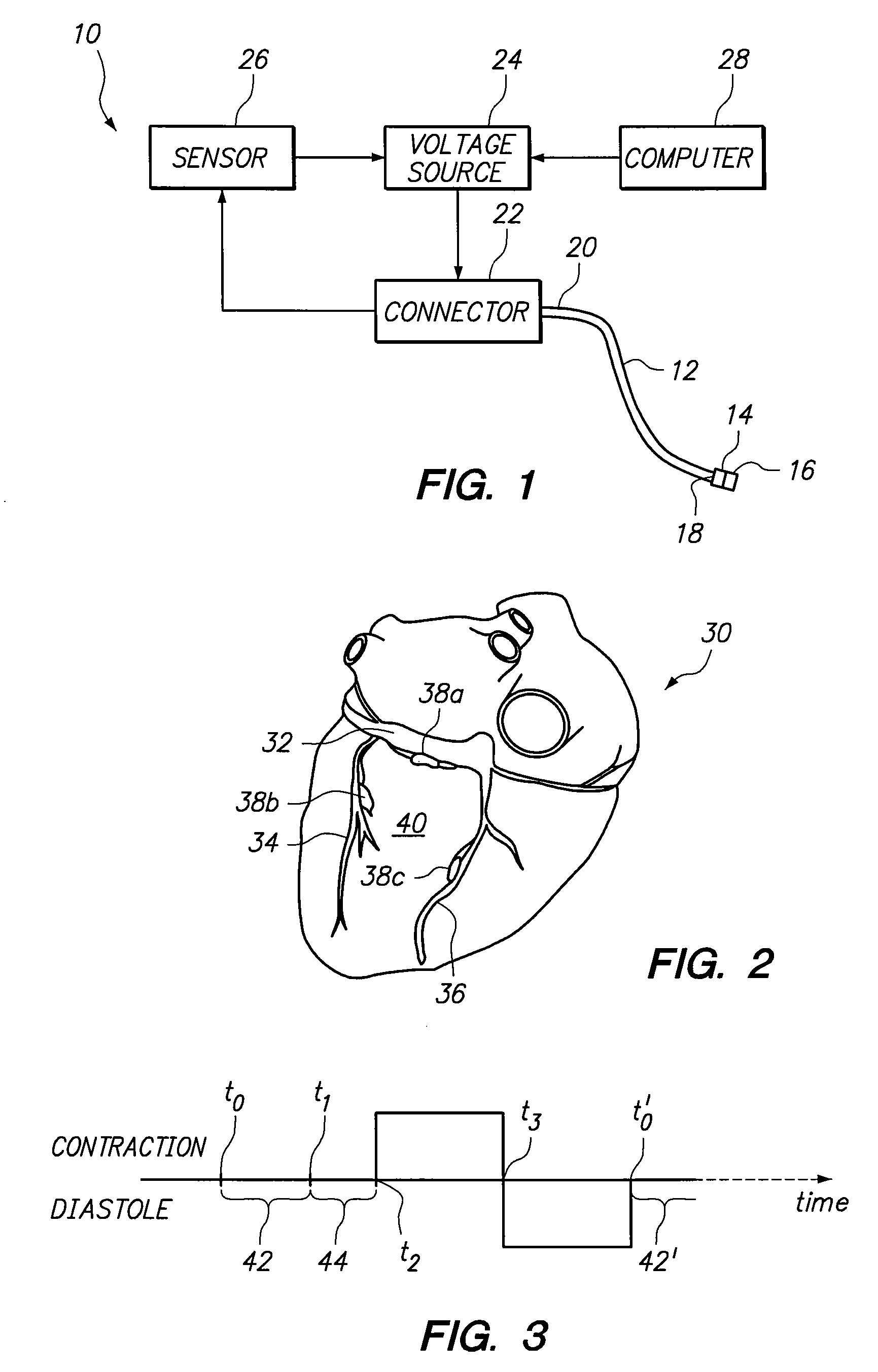 System and method for transvascular activation of cardiac nerves to improve heart function