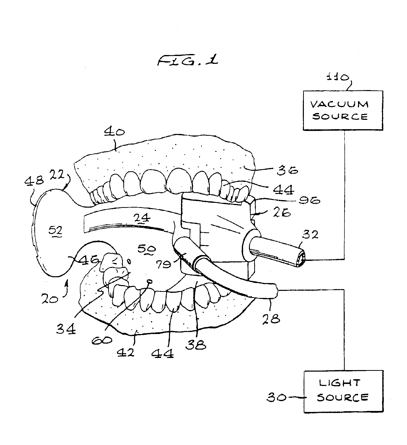 Intraoral device and method of using the same