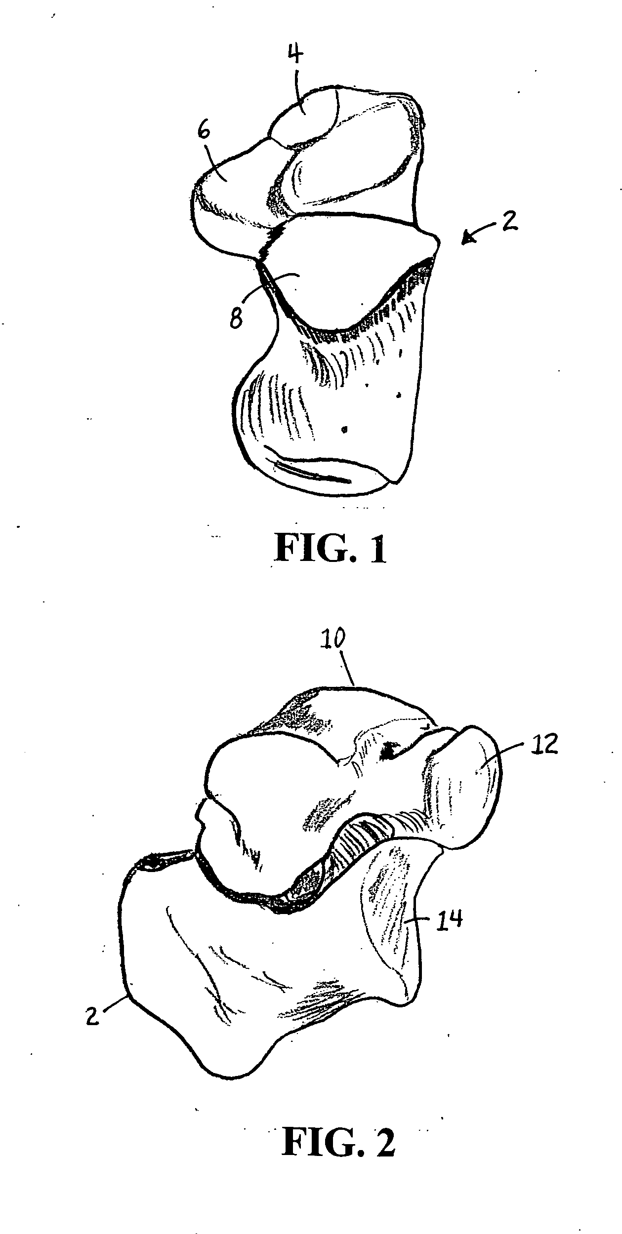 Catheter deliverable foot implant and method of delivering the same