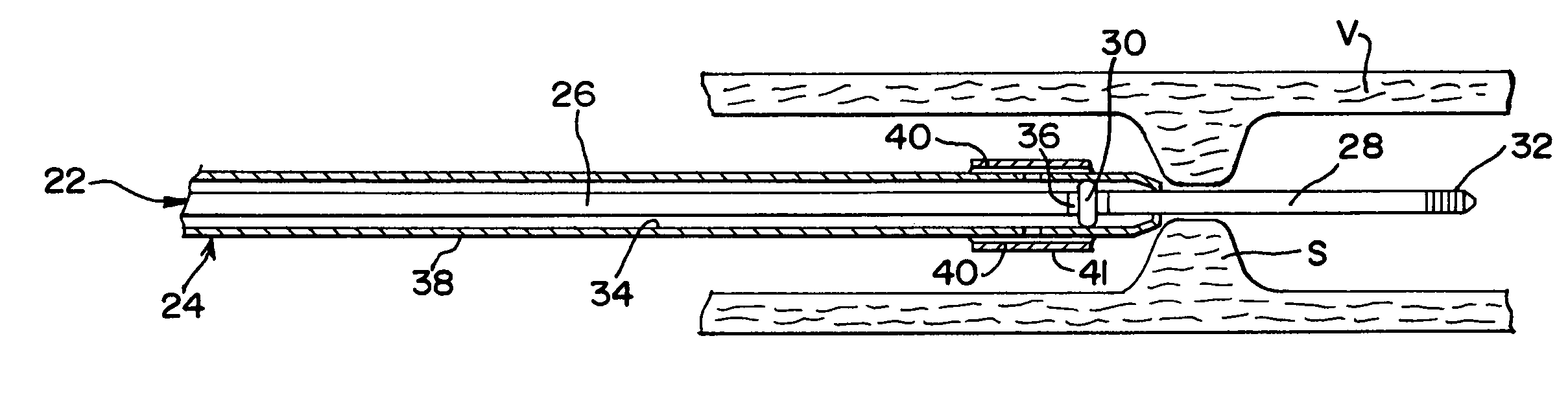 Guidewire with distal expansion feature and method for enhancing the deliverability and crossability of medical devices