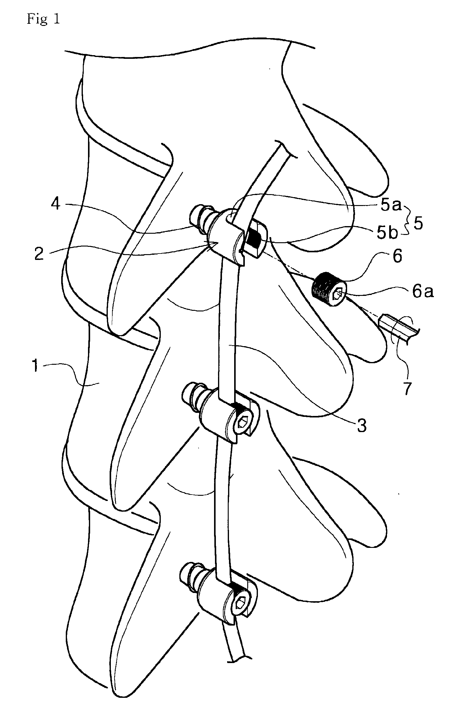 Pedicle screw and device for injecting bone cement into bone