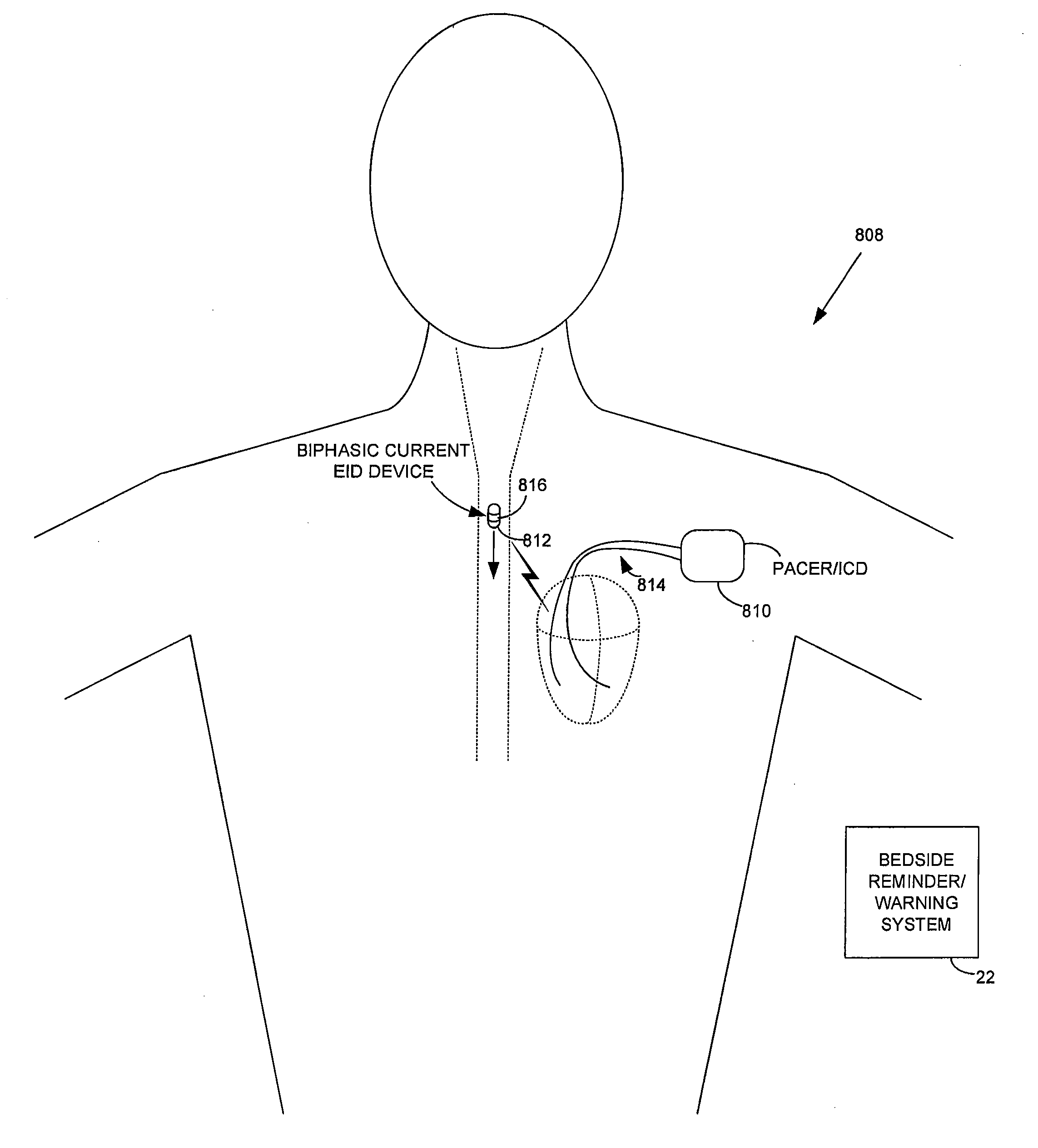 Method and apparatus for monitoring ingestion of medications using an implantable medical device