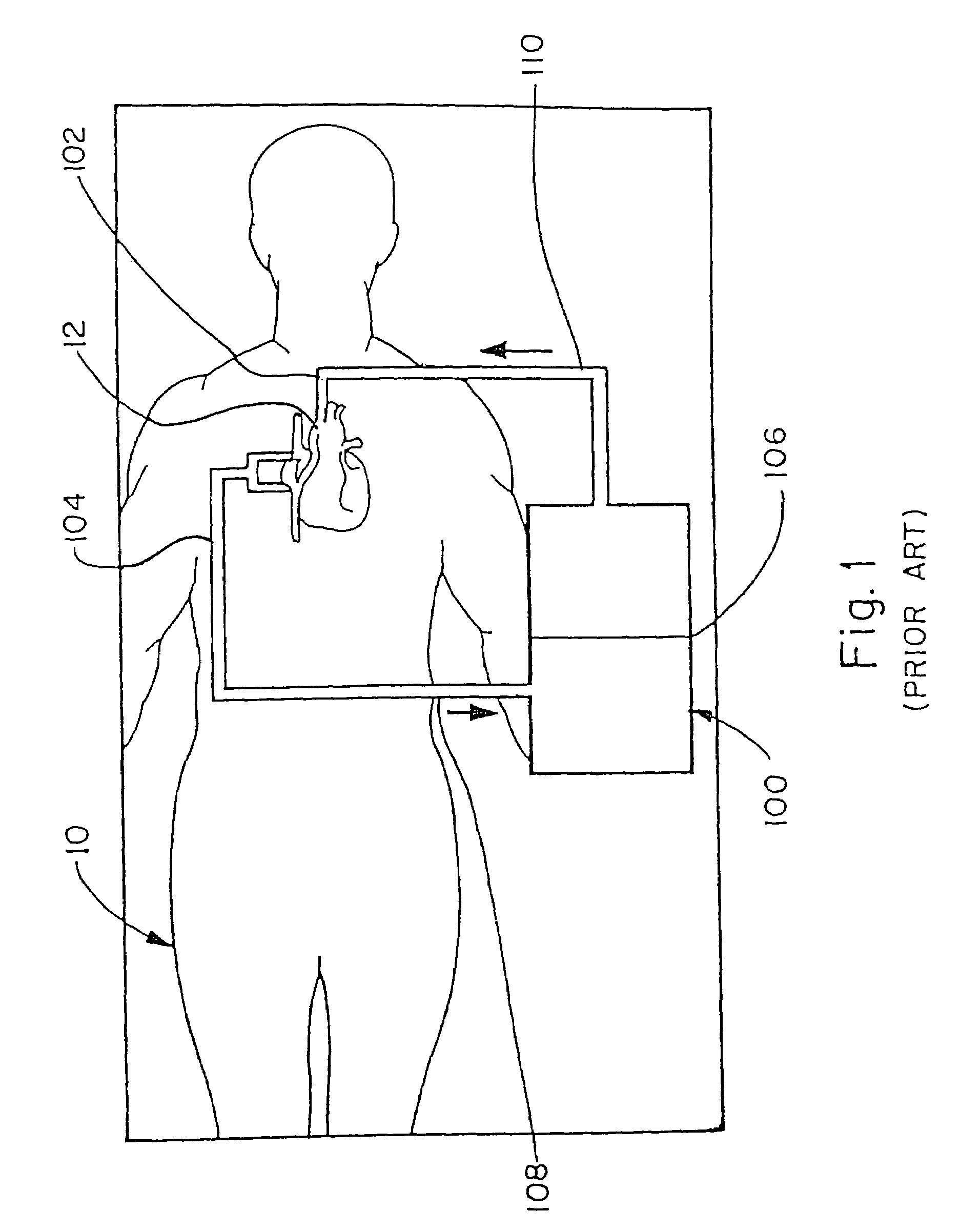 Method of recovering blood from an extracorporeal circuit