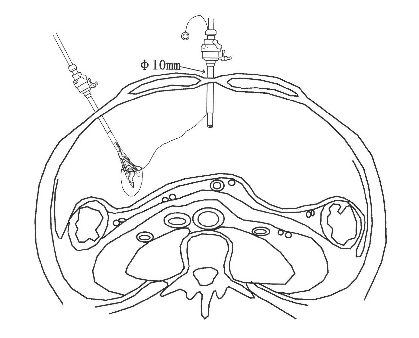 Specimen extraction bag for laparoscope operation