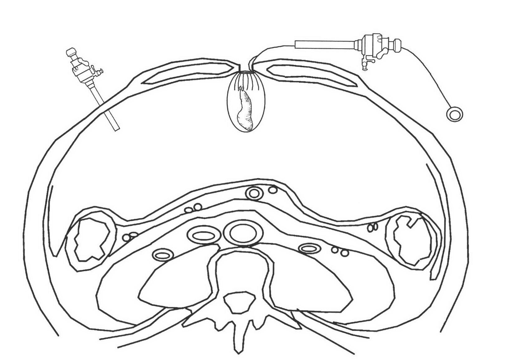 Specimen extraction bag for laparoscope operation