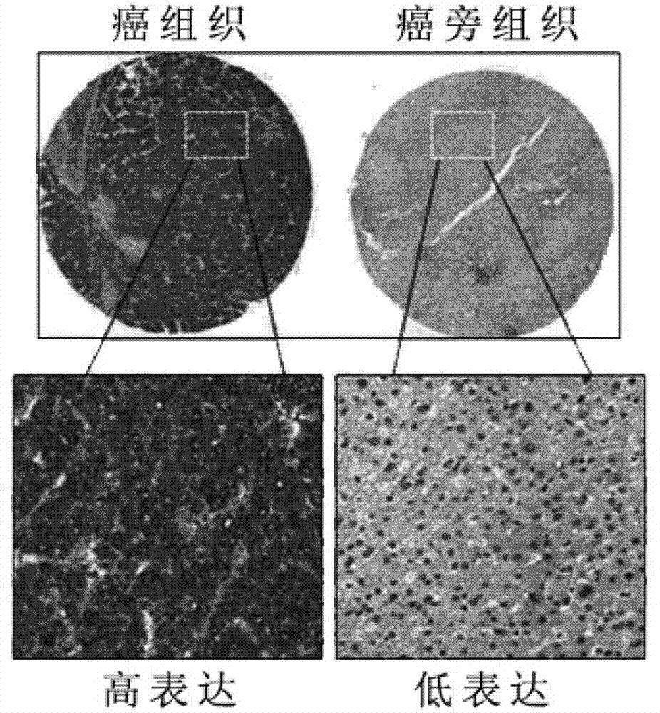 Application of PSMD4 protein in preparation of liver cancer prognostic evaluation kit