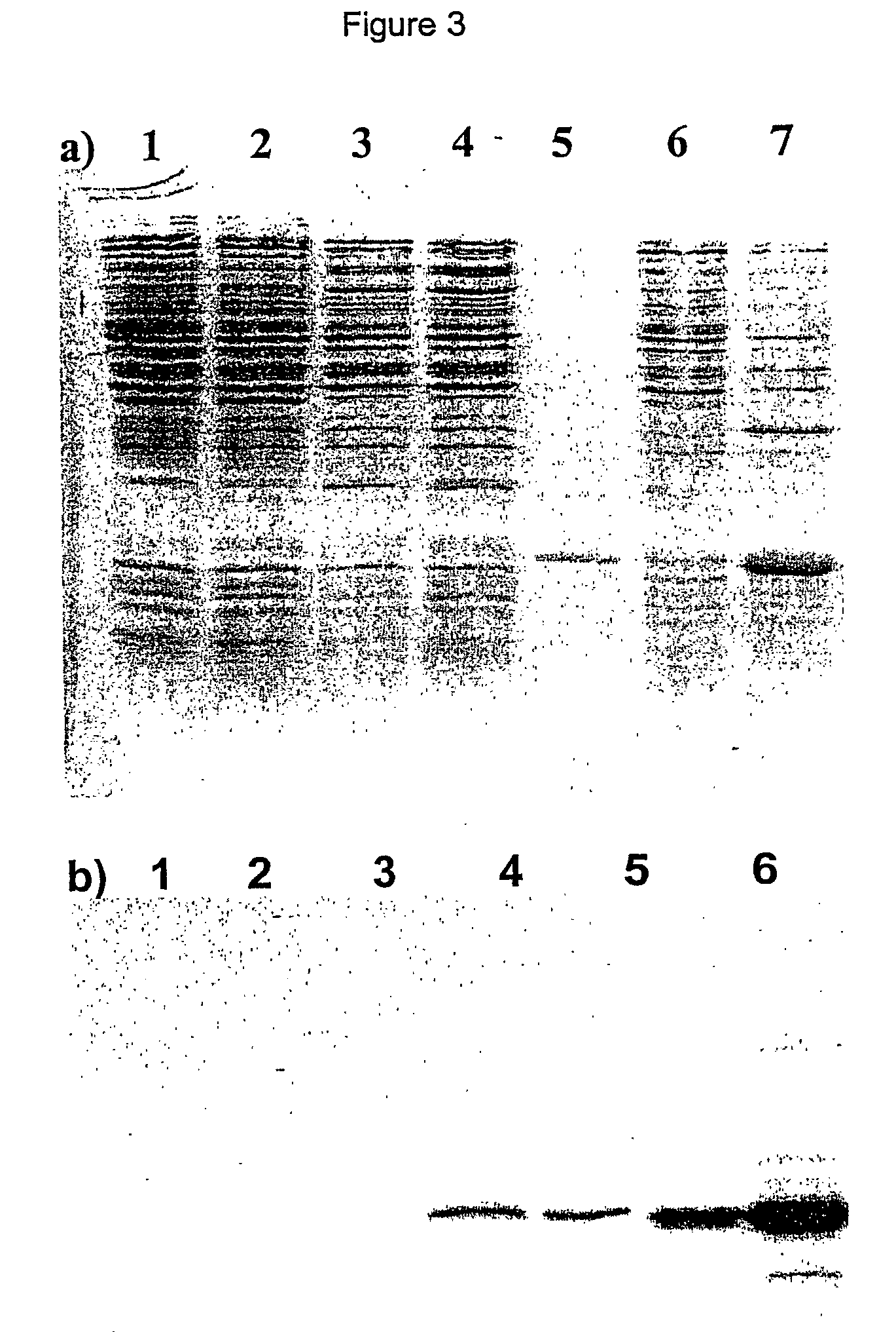 Synthetic gene coding for human granulocyte-colony stimulating factor for the expression in <i>E. coli </i>