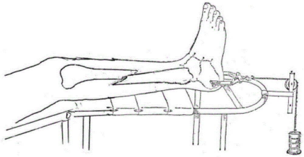 Combined type multifunctional physiological bone pressurization external fixation support