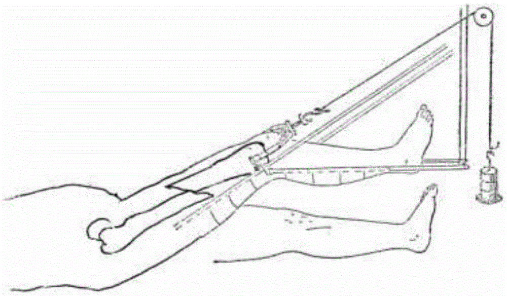 Combined type multifunctional physiological bone pressurization external fixation support