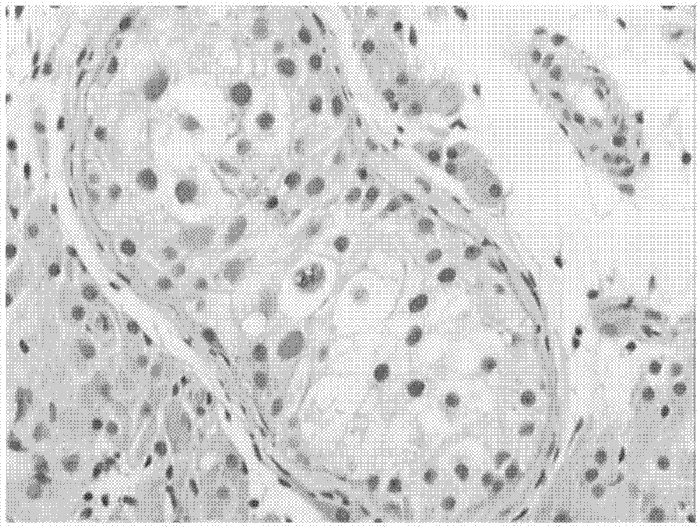 Male infertility related genetic marker