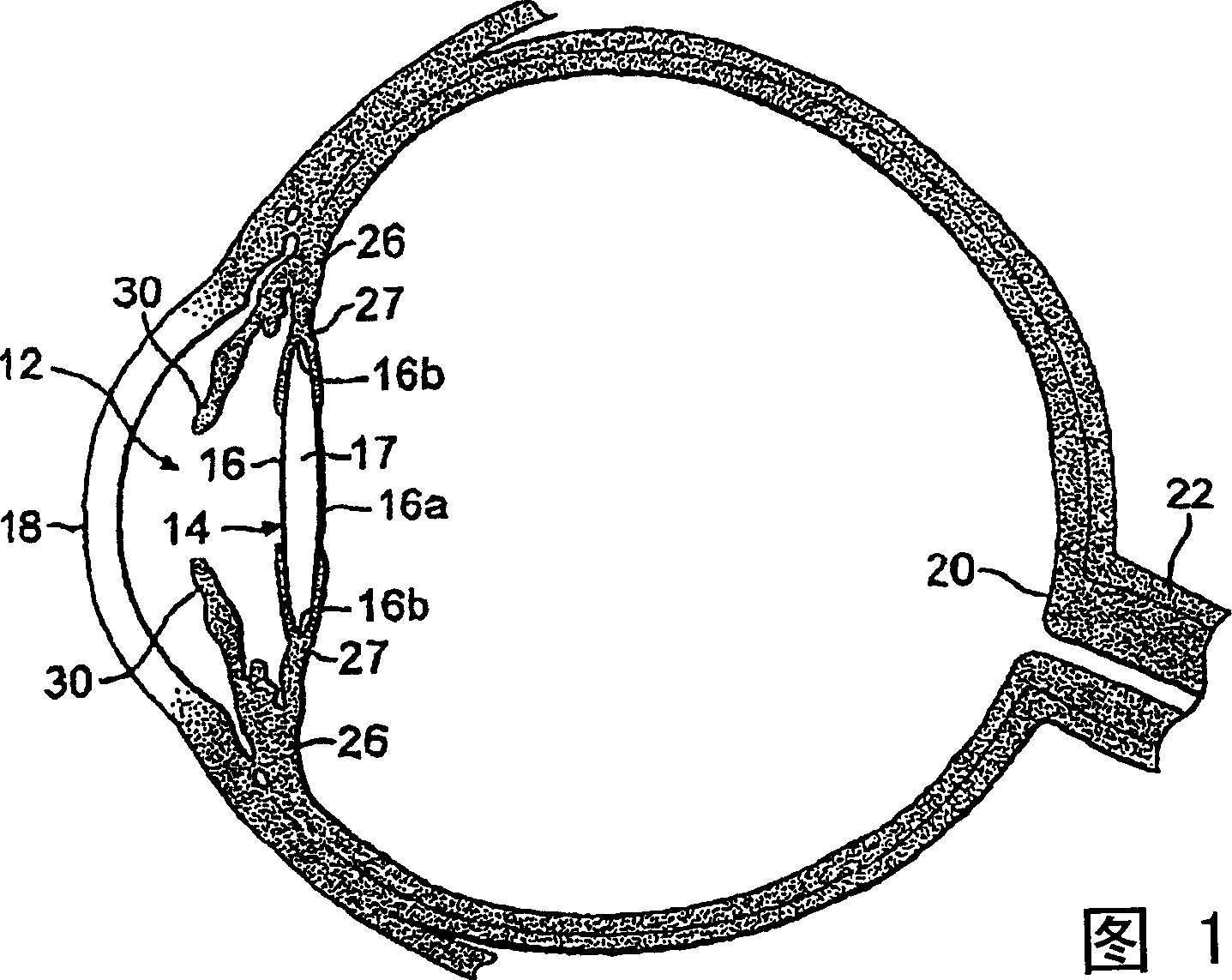 Intraocular lens for inhibiting pco and aco