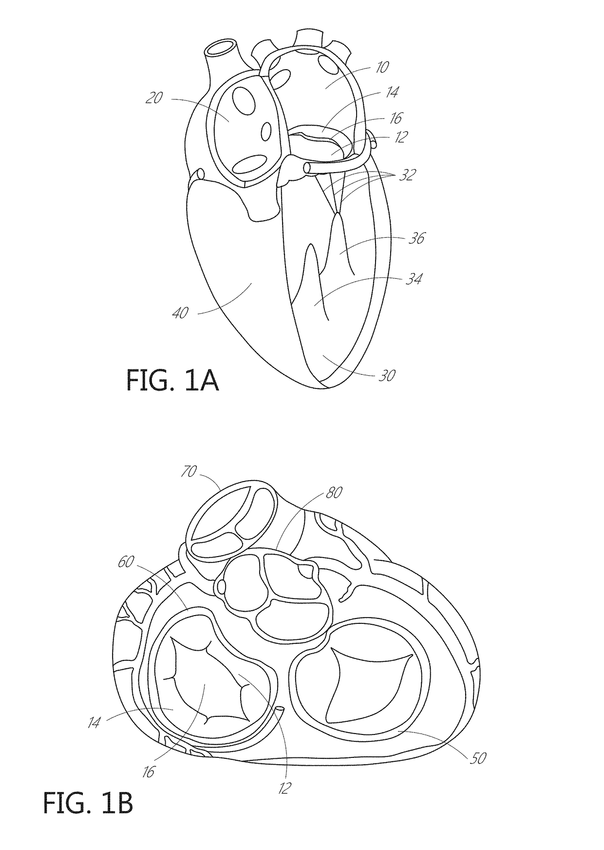 Device, system, and method for transcatheter treatment of valvular regurgitation