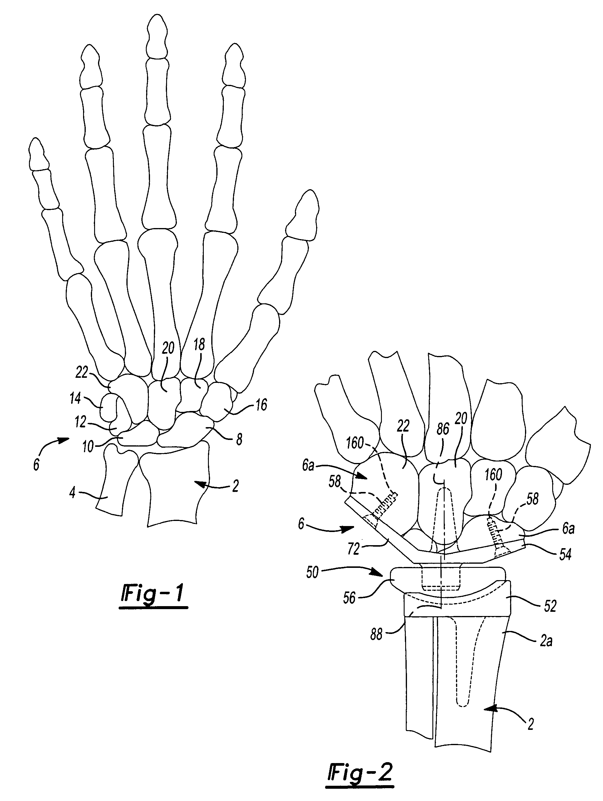 Method and apparatus for wrist arthroplasty