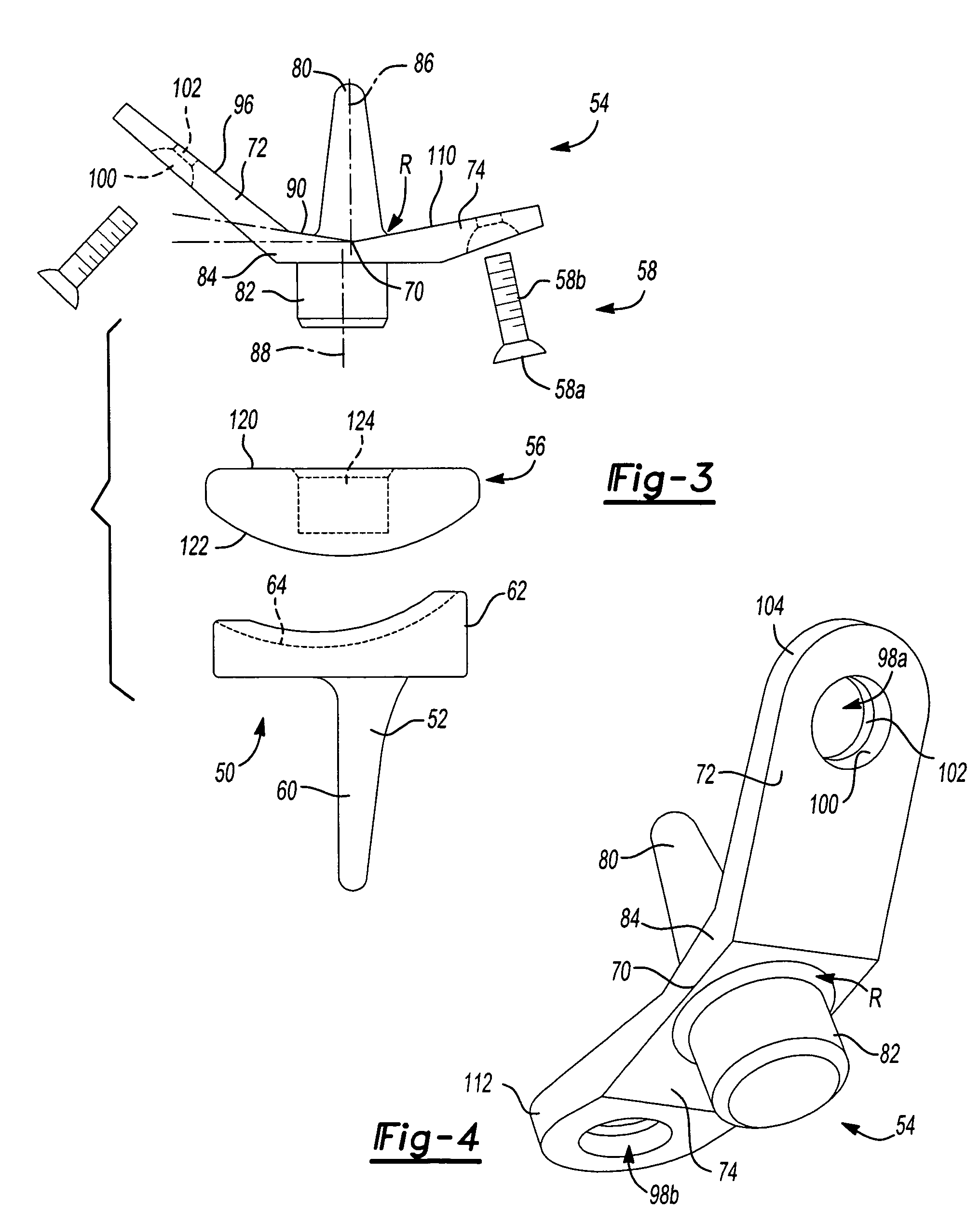 Method and apparatus for wrist arthroplasty