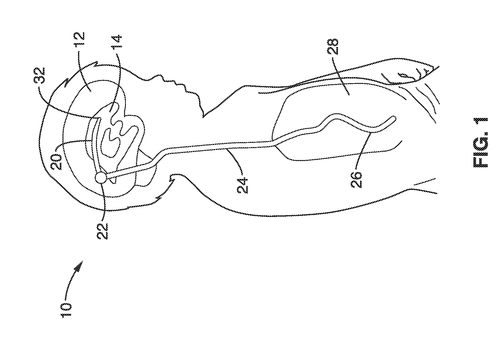 Unobstructing microdevices for self-clearing implantable catheters