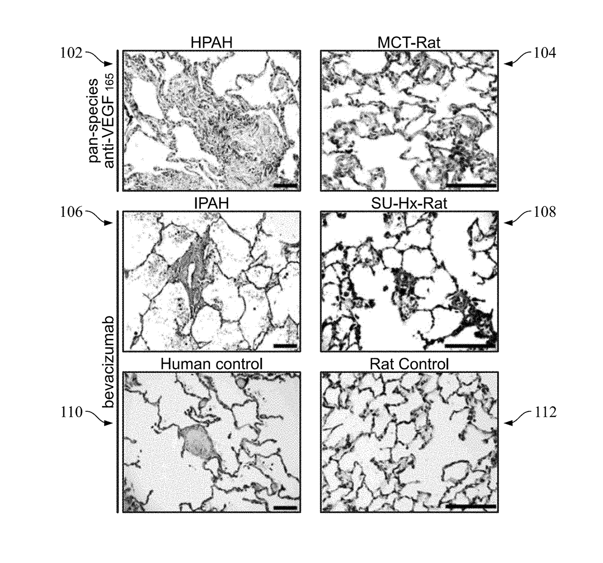 Imaging probe for angiogenic activity in pulmonary arterial hypertension