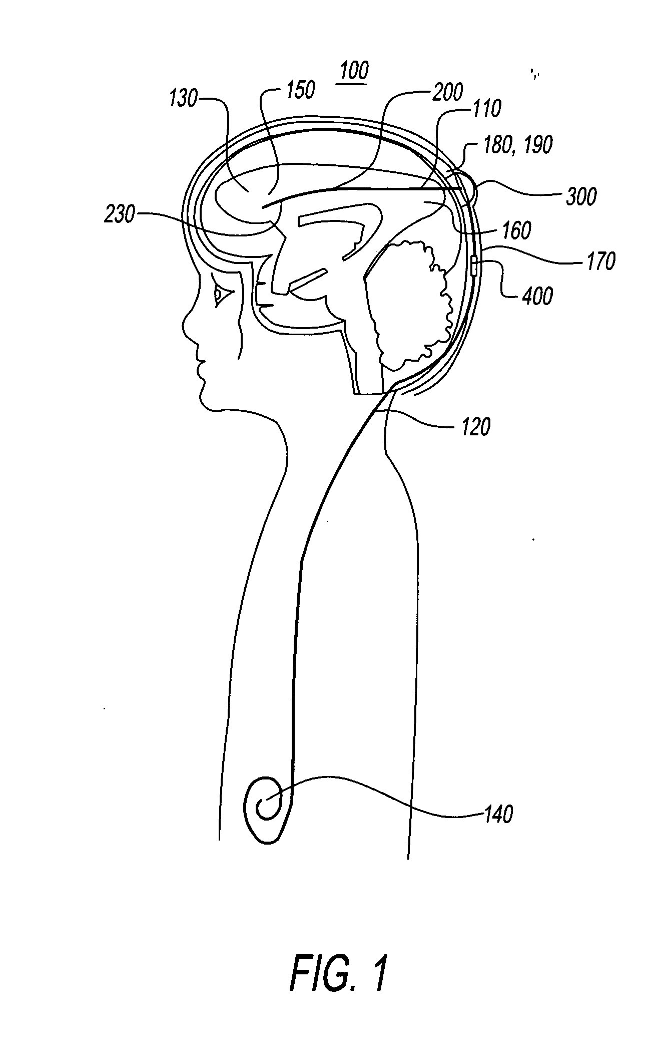 No clog shunt using a compact fluid drag path