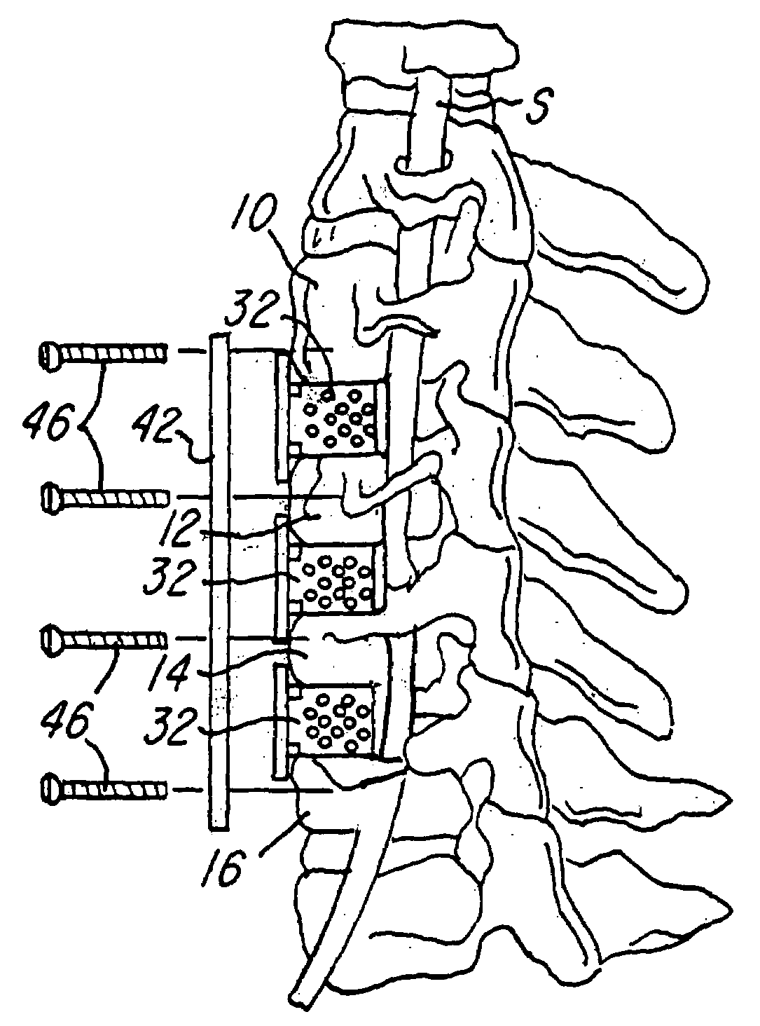 Spinal fusion system and method for fusing spinal bones