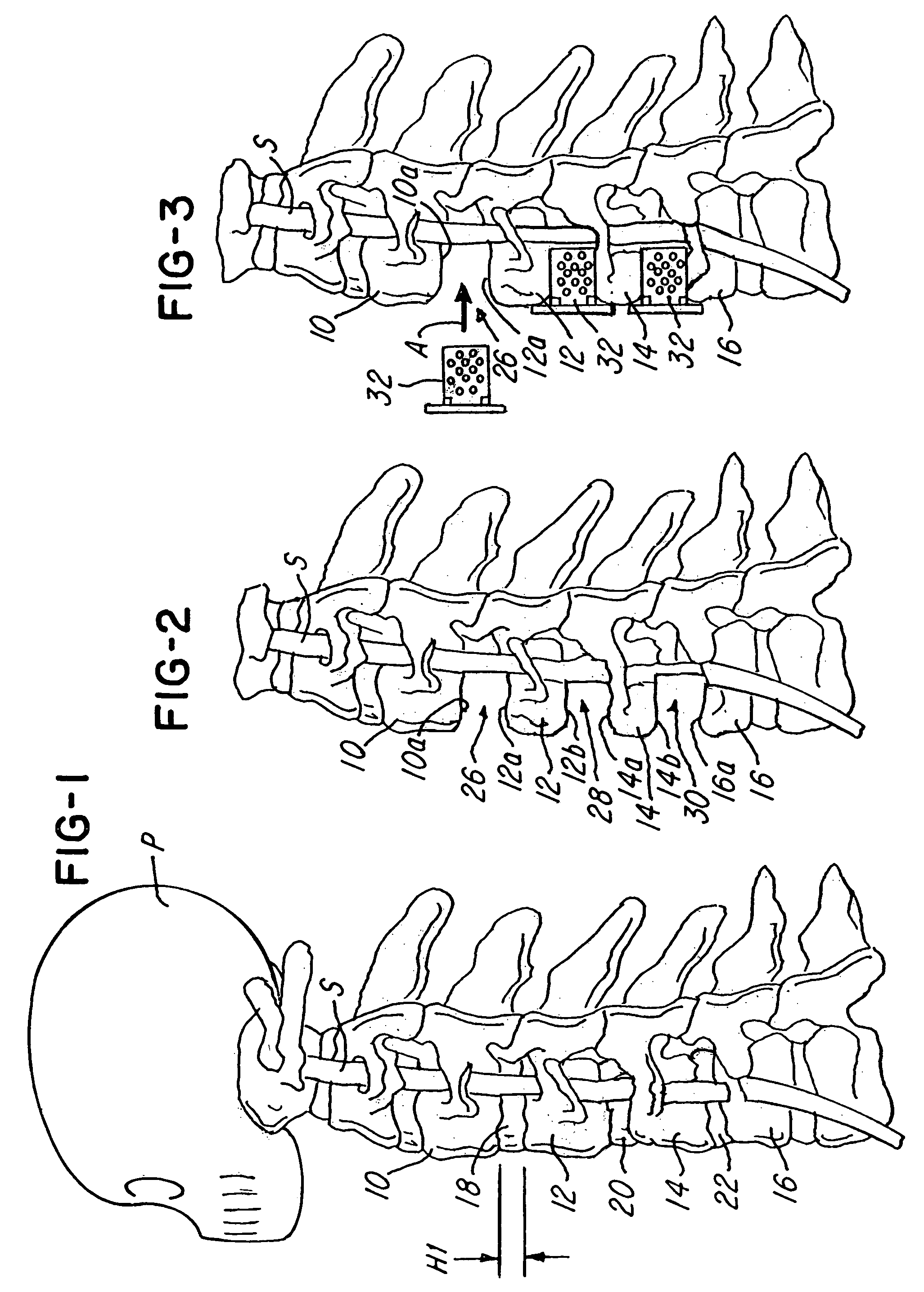 Spinal fusion system and method for fusing spinal bones