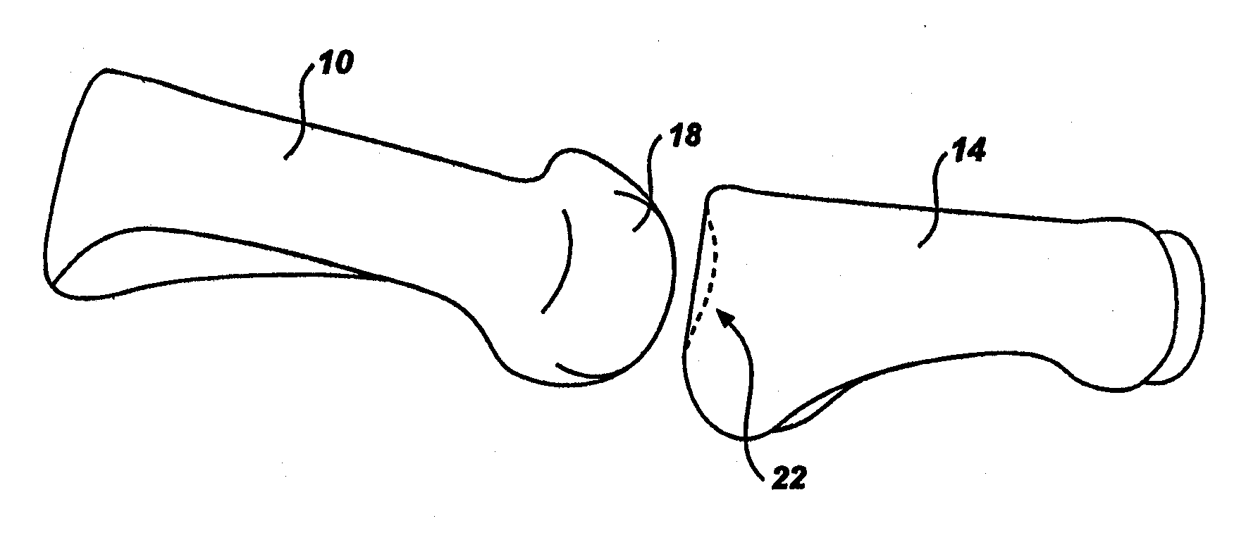 Artificial toe joint