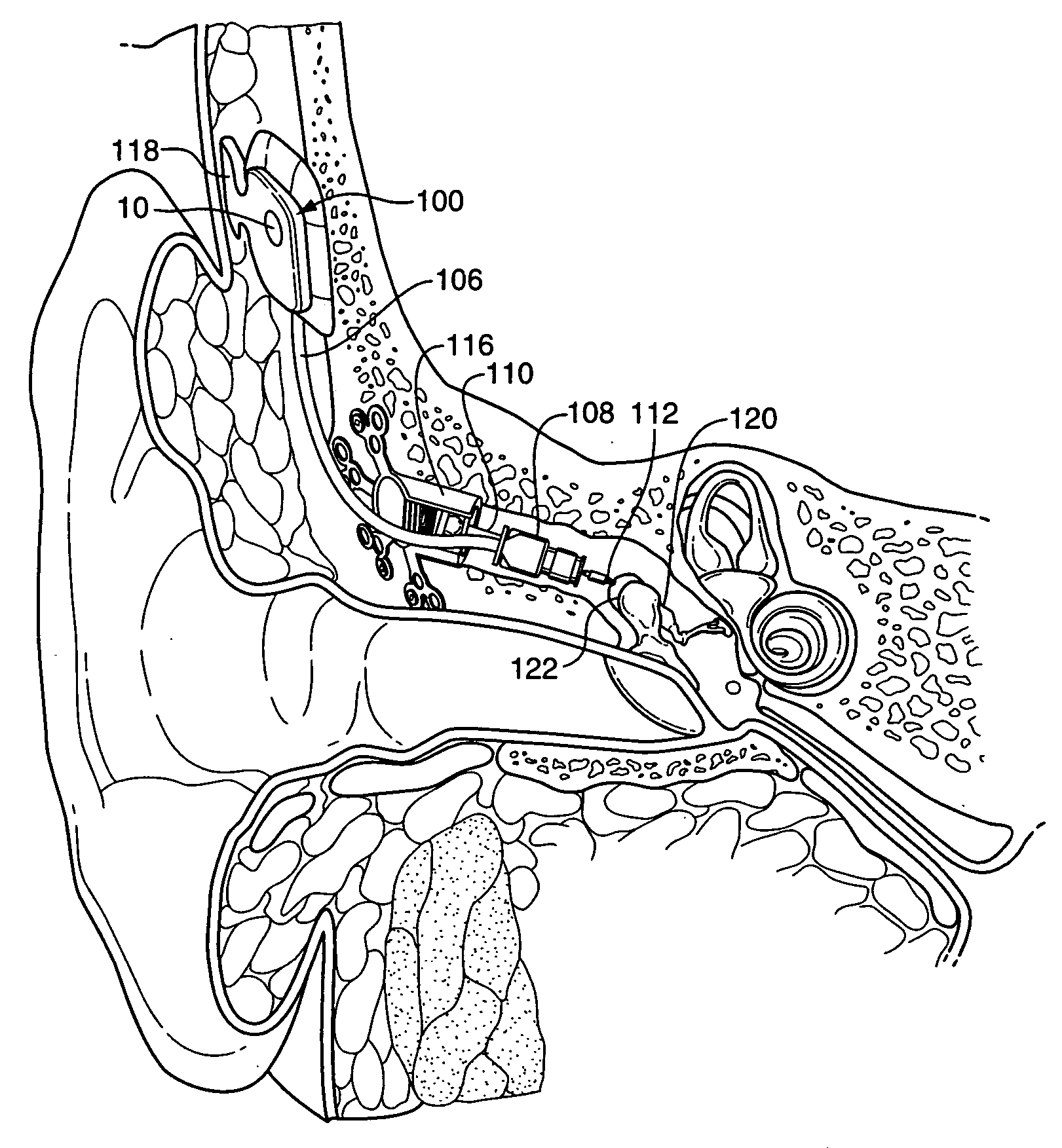 Microphone optimized for implant use