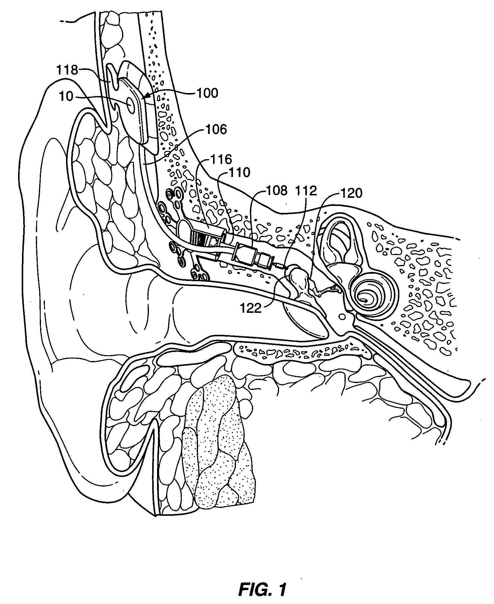 Microphone optimized for implant use