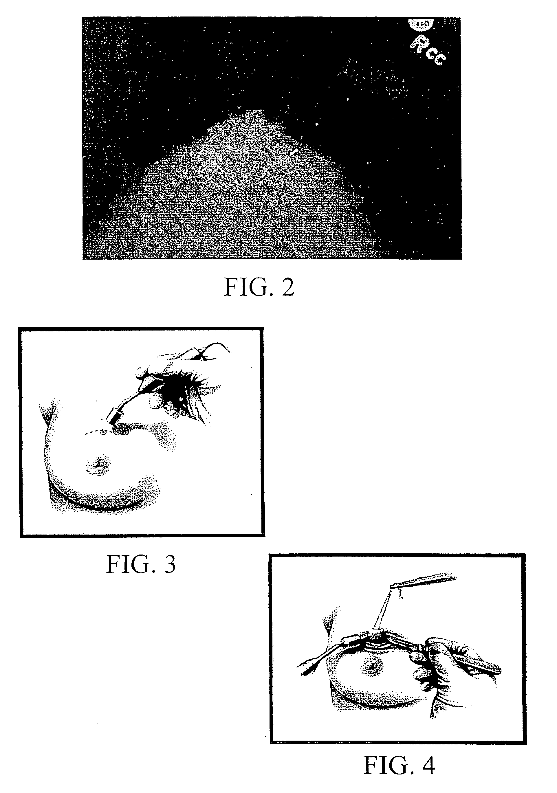 Radio guided seed localization of imaged lesions