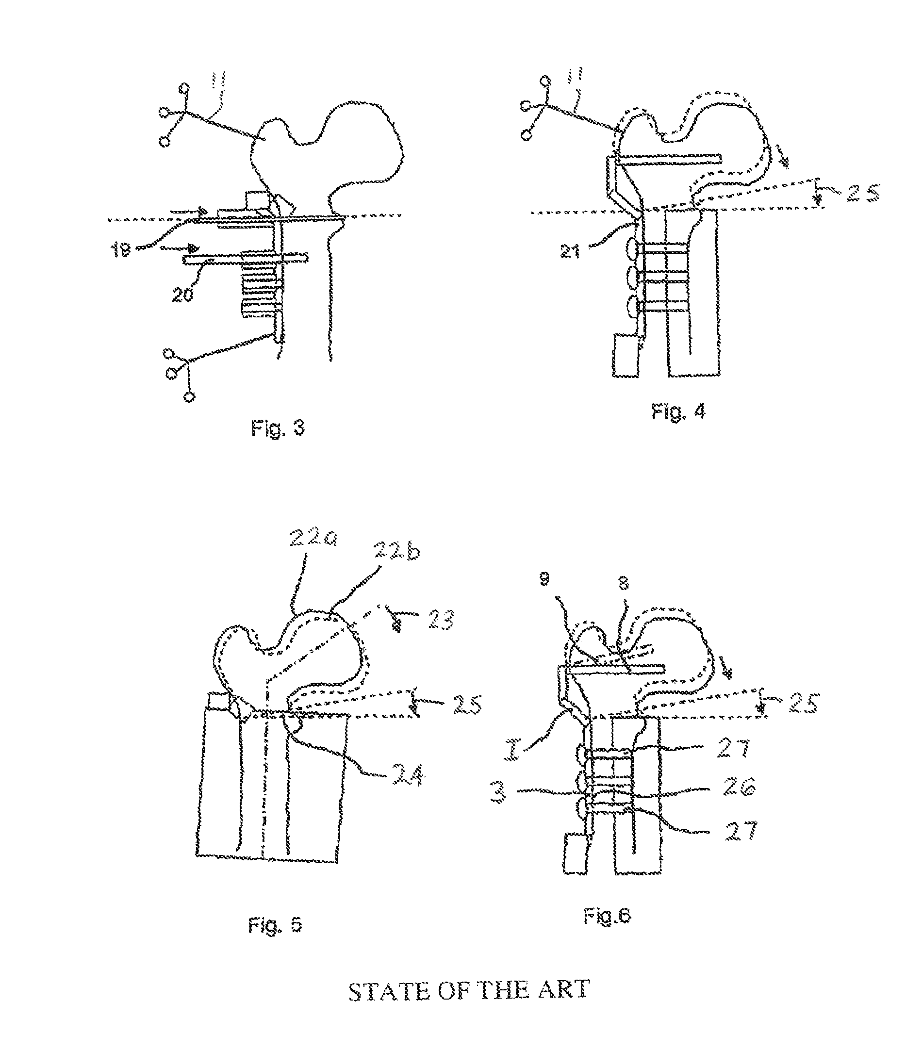 Implant location positioning system