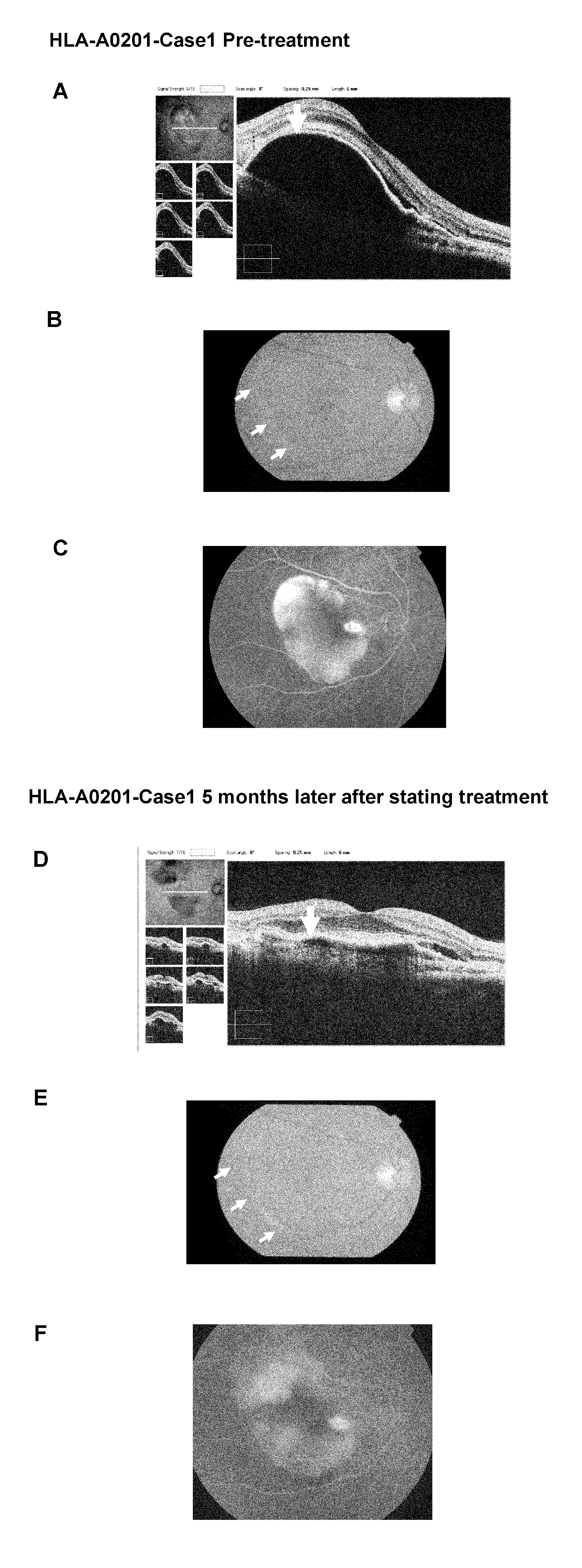 Vaccine therapy for choroidal neovascularization