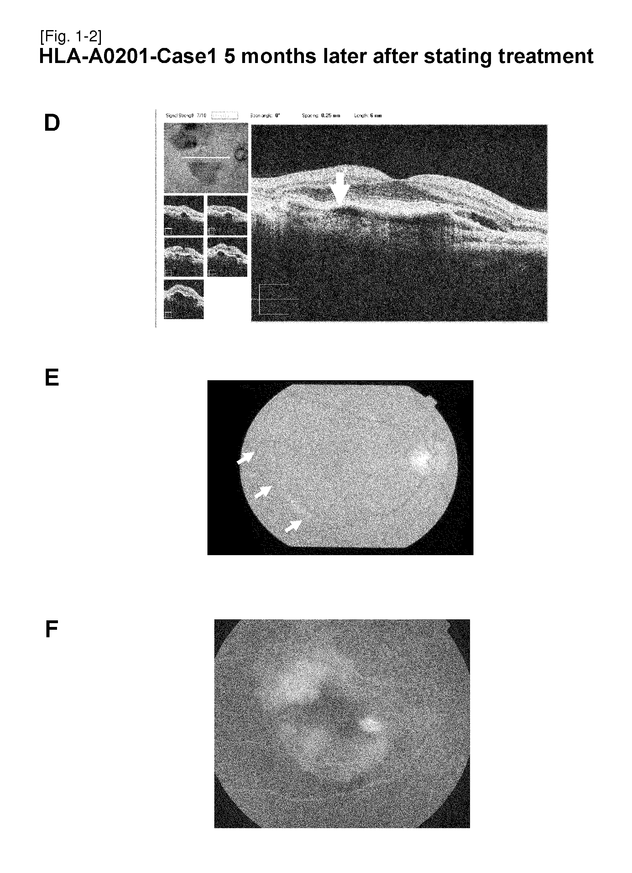 Vaccine therapy for choroidal neovascularization