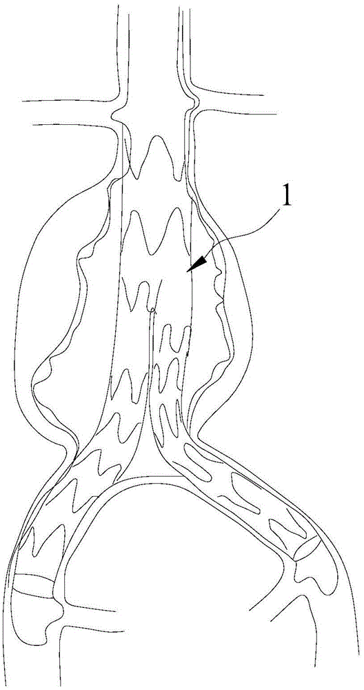 Multi-channel membrane-coated intravascular stent and preparation method thereof