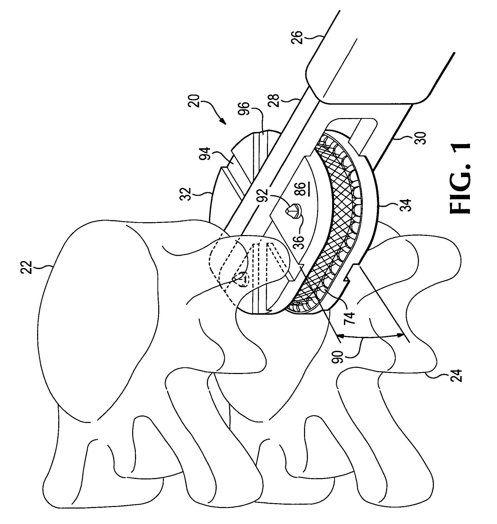 Anatomic total disc replacement