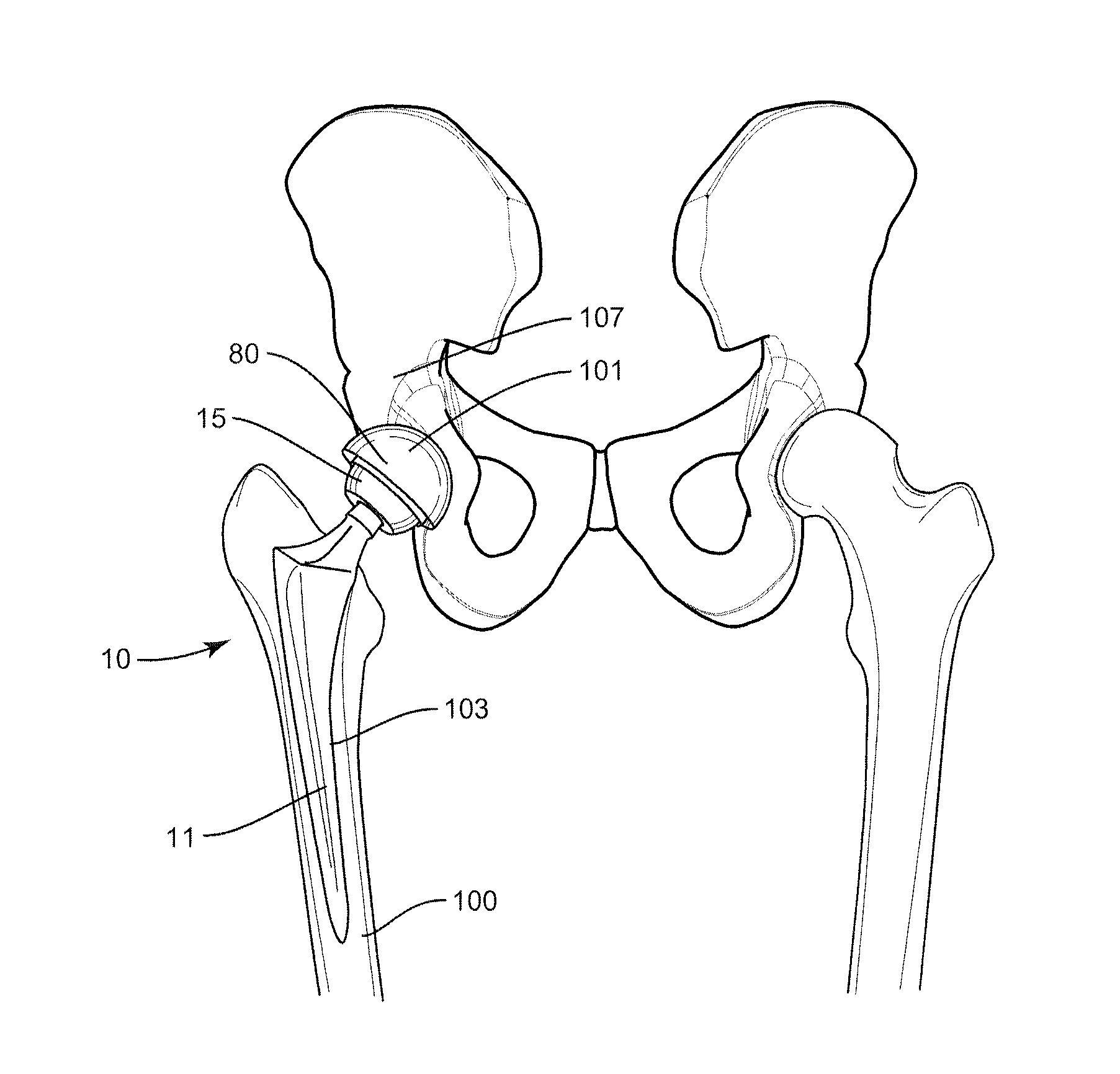 Methods and Devices for a Surgical Hip Replacement Procedure