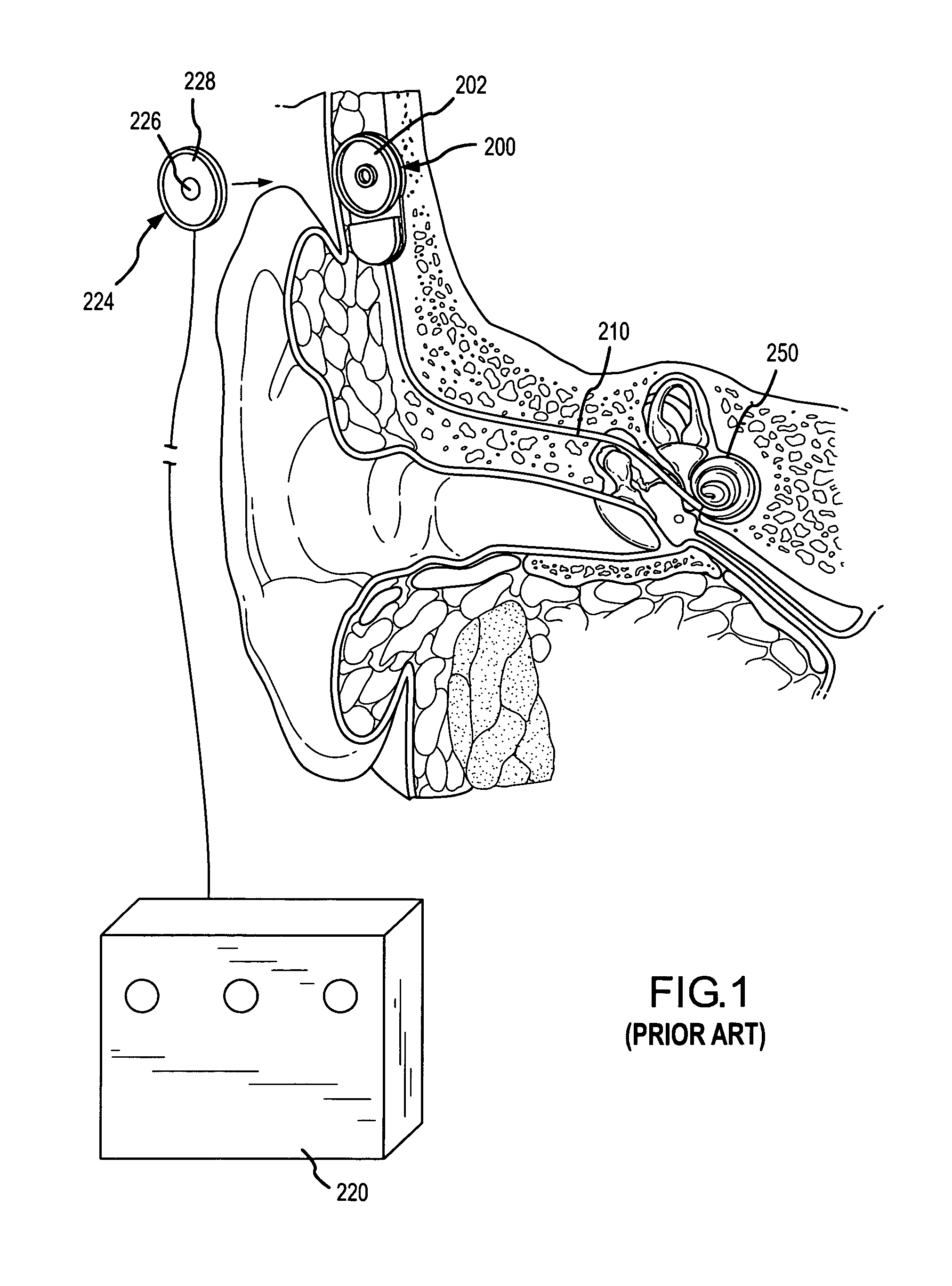 Integrated implantable hearing device, microphone and power unit