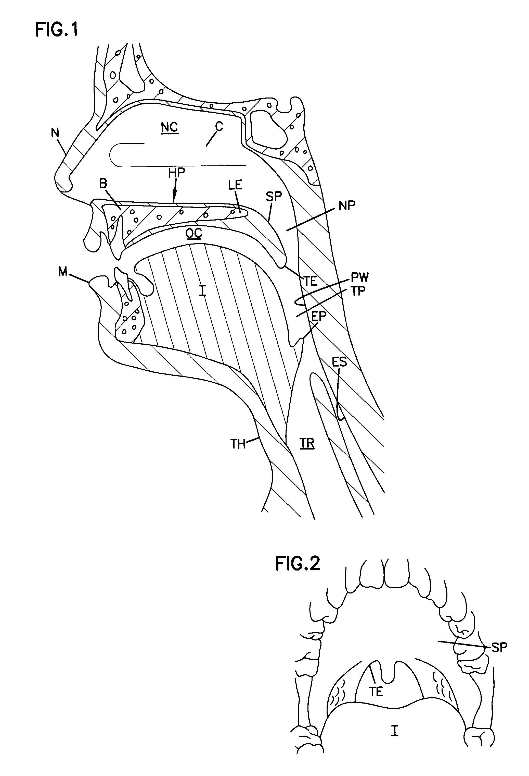 Airway implant cartridge and kit