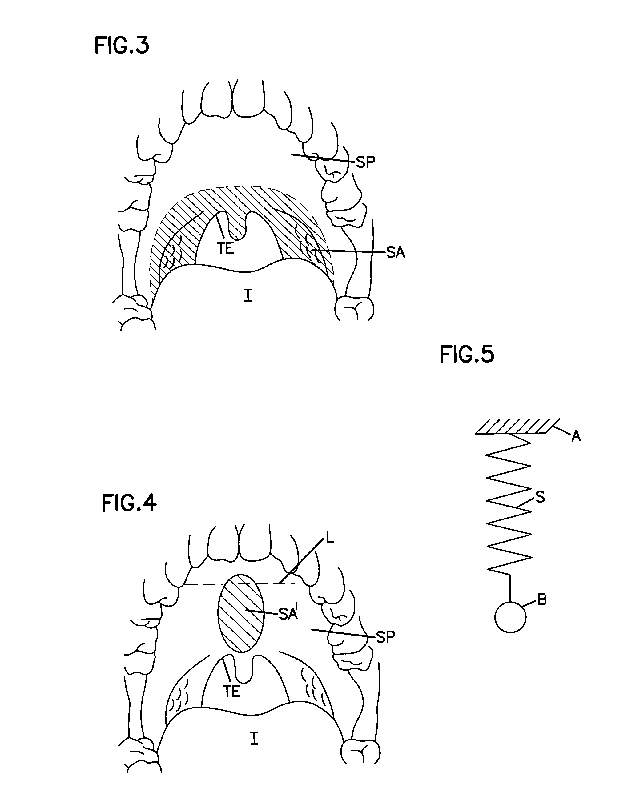 Airway implant cartridge and kit