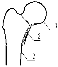 Fitting-type bone fracture plate for inner side of femoral neck