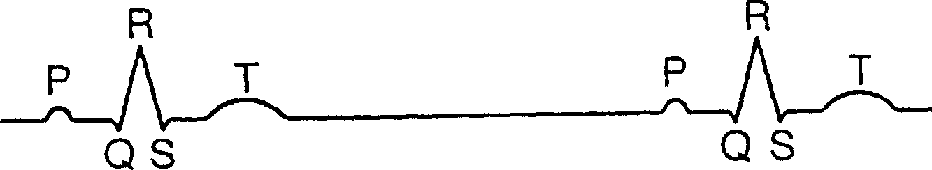 Method of treating a living organism to achieve a heart load reduction, and apparatus for carrying out the method