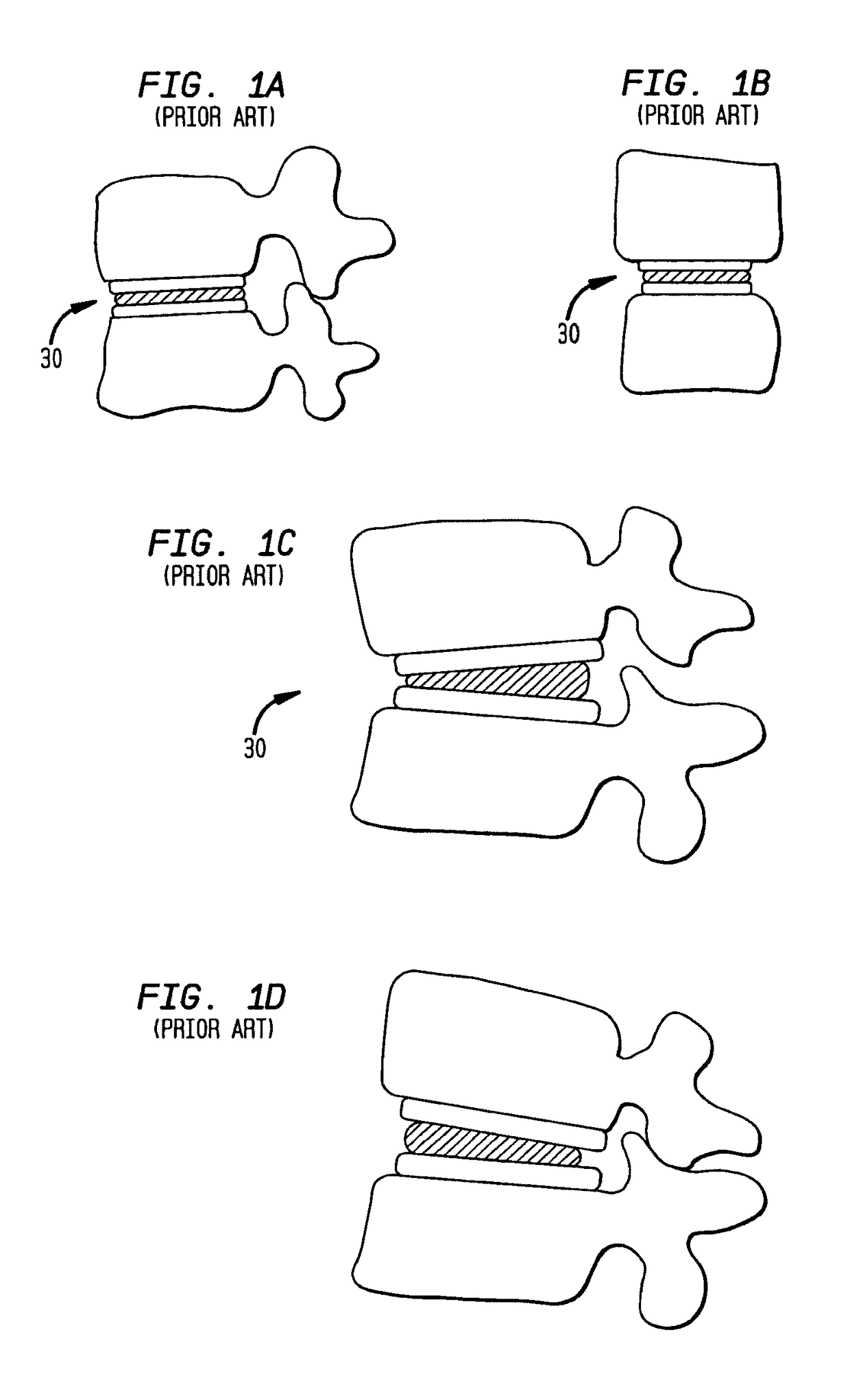 Two-component artificial disc replacements