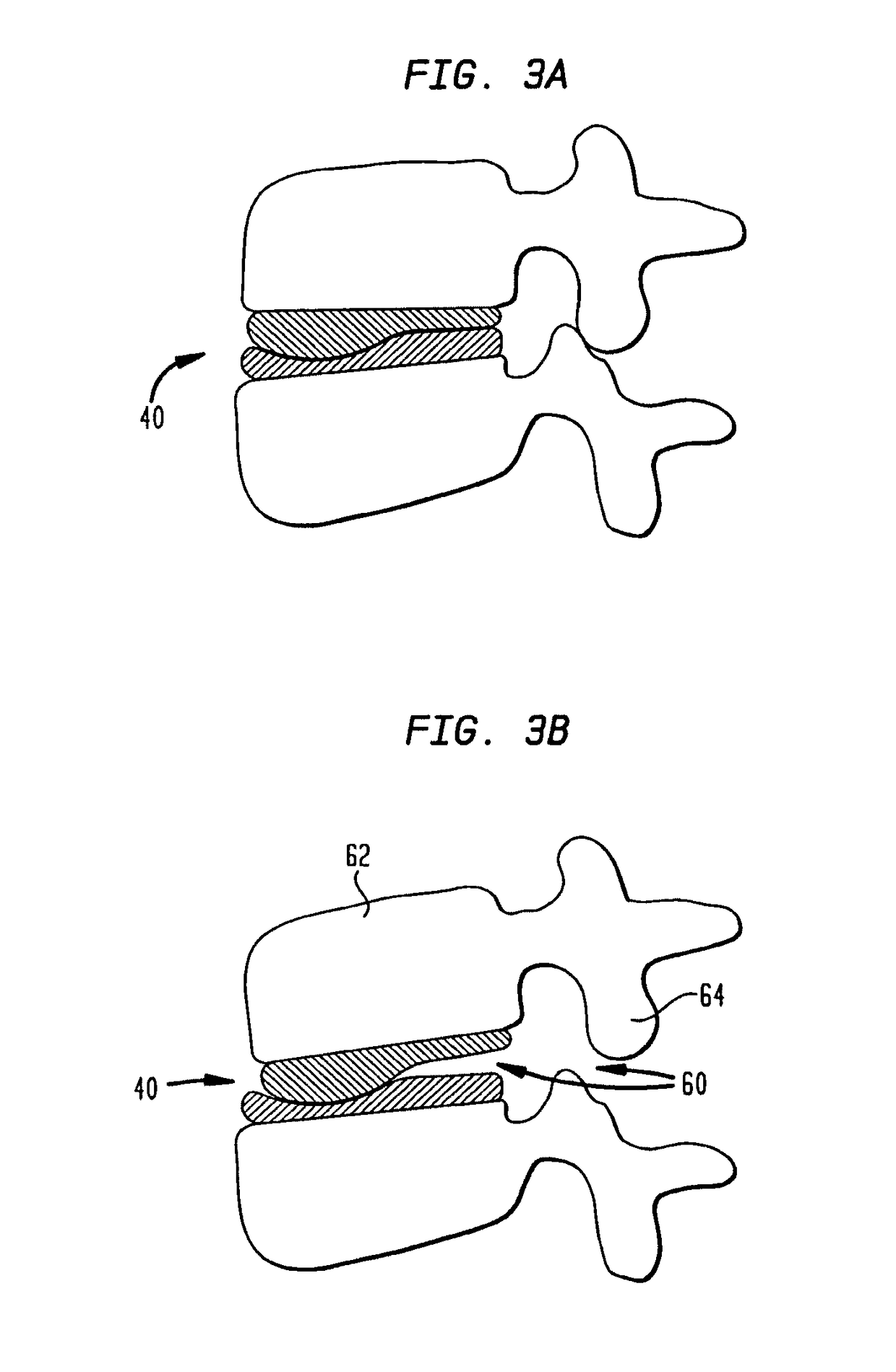 Two-component artificial disc replacements