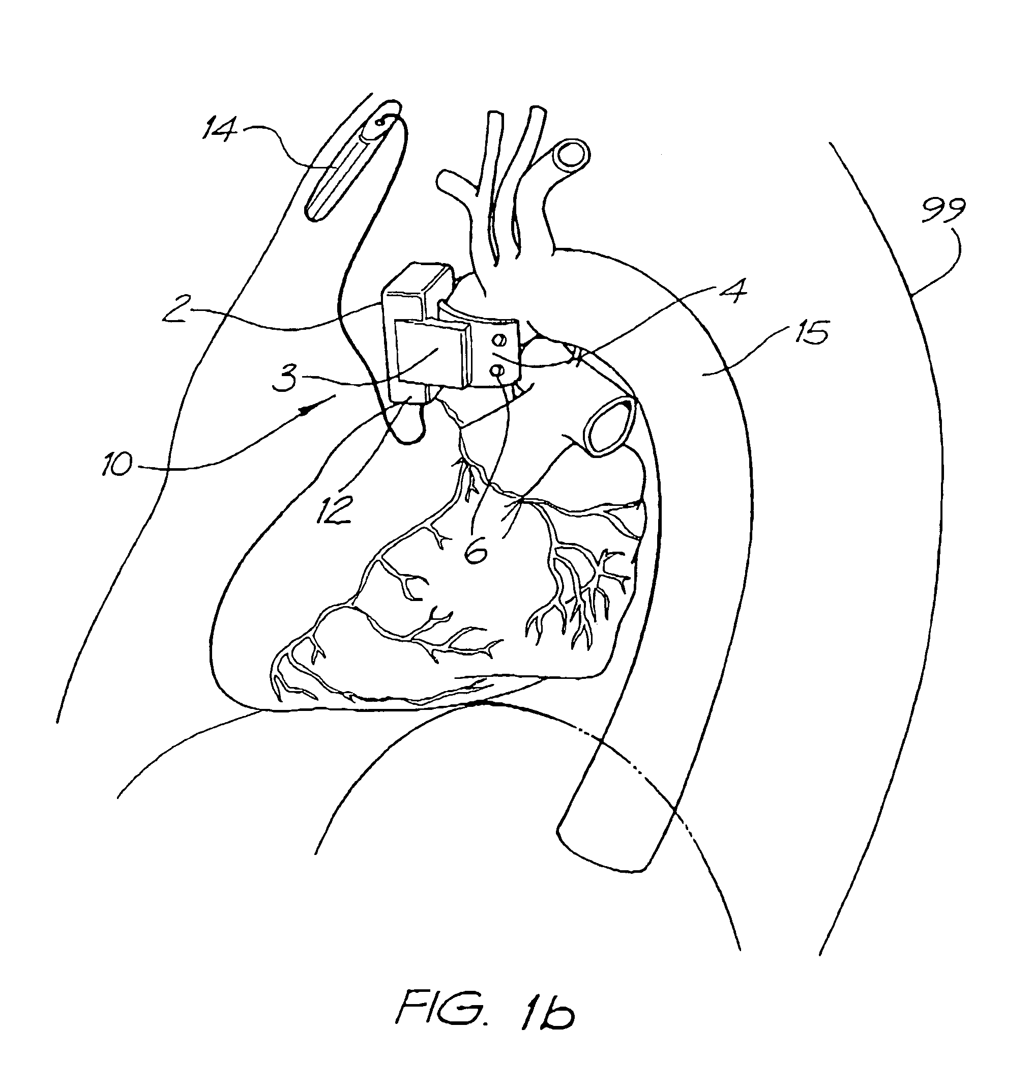 Heart assist devices, systems and methods